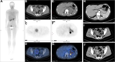 99mTc-FAPI-04 SPECT/CT outperforms contrast-enhanced CT in detecting metastasis in postoperative patients with colorectal cancer